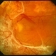 Fibrovascular Proliferation